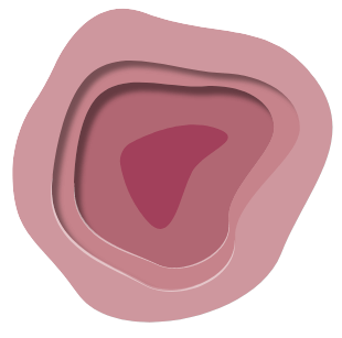 Inflamed Diabetic Foot Ulcer Illustration